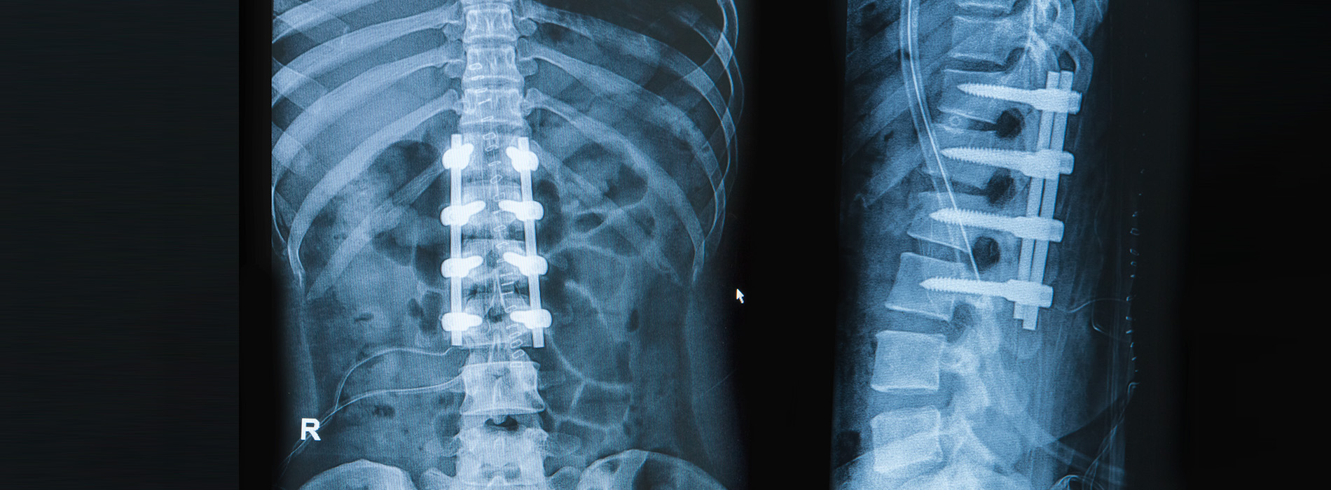 The image shows three X-rays of human spines, with each spine exhibiting varying degrees of curvature and alignment, displayed in a collage format.